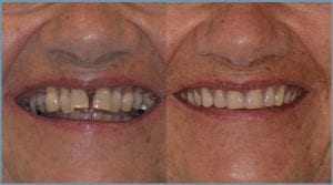 Yvonne Before and After Dental Implants